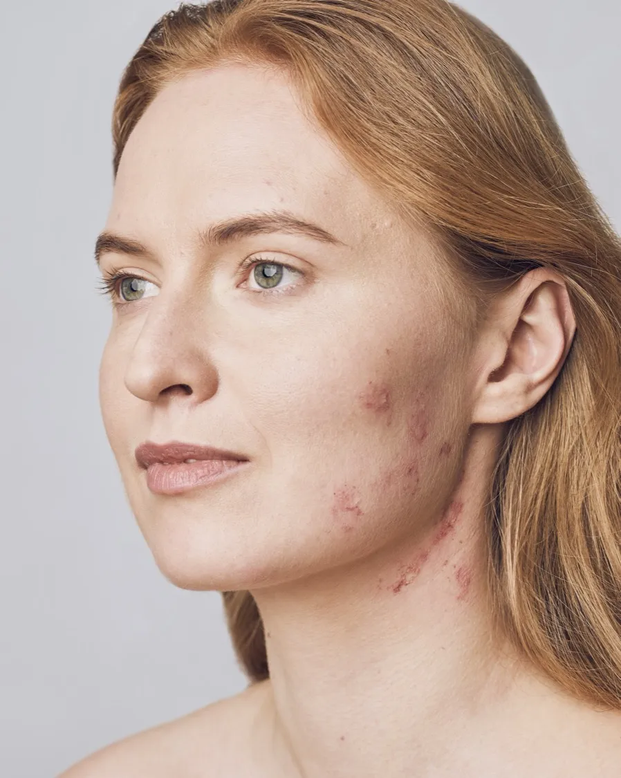 Eczema-prone skin with red, rough patches on the cheek and neck