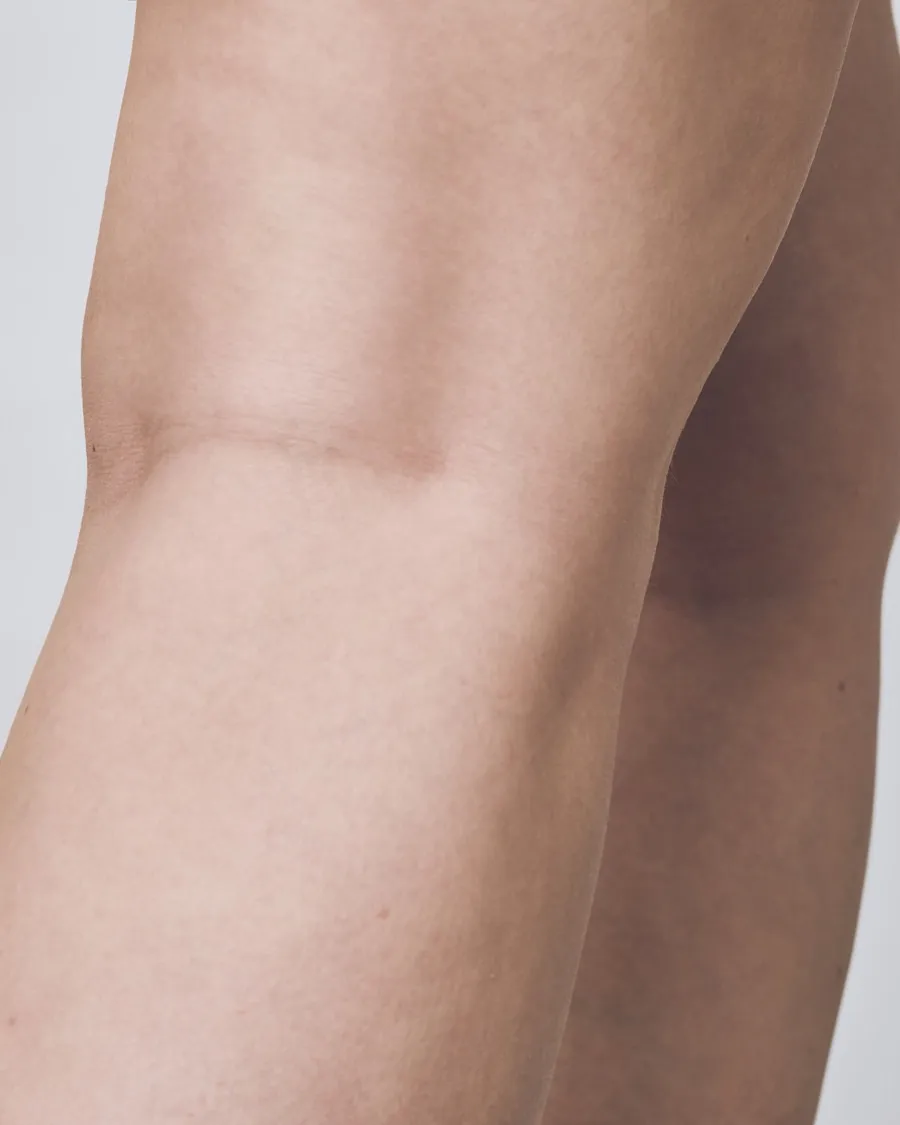 The same knee, calm and clear after 3 weeks