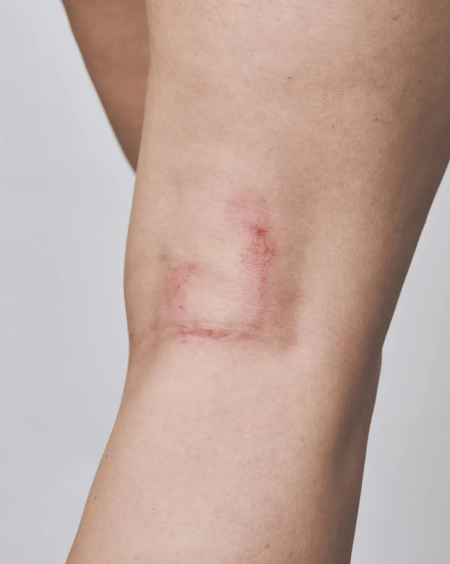 A red, rough eczema patch on the knee
